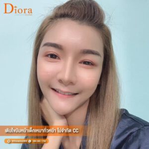 ฉีดไขมันหน้า