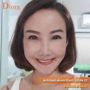ฉีดไขมันหน้า