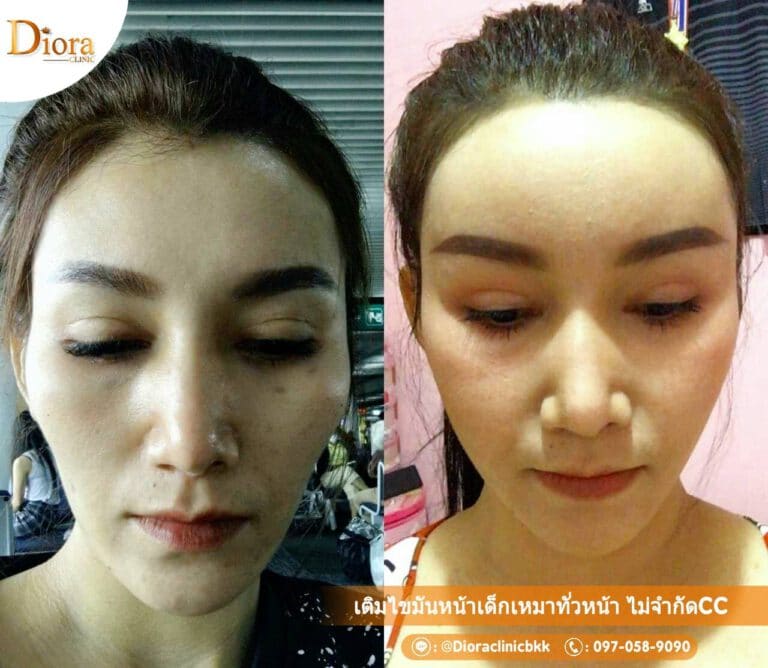 ฉีดไขมันหน้า