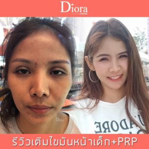 ฉีดไขมันหน้า