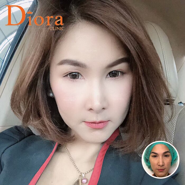 ฉีดไขมันหน้า