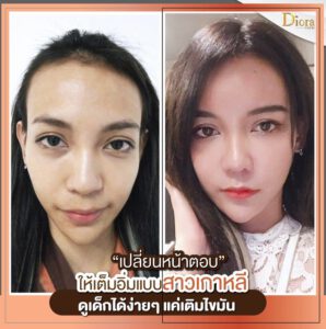 ฉีดไขมันหน้าเด็ก