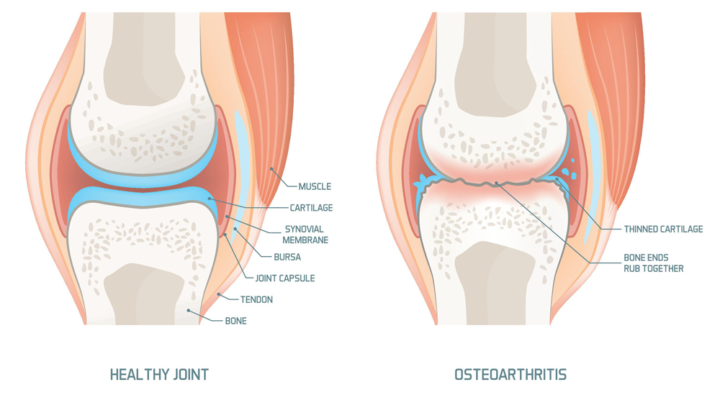 osteoarthritis