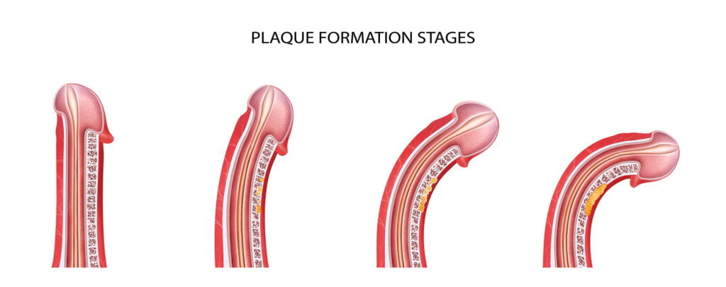 PRP Penis