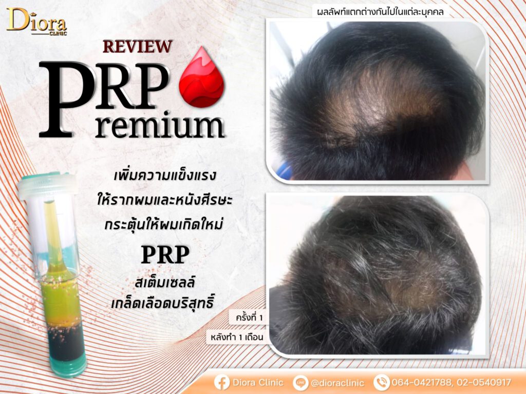 PRP hair