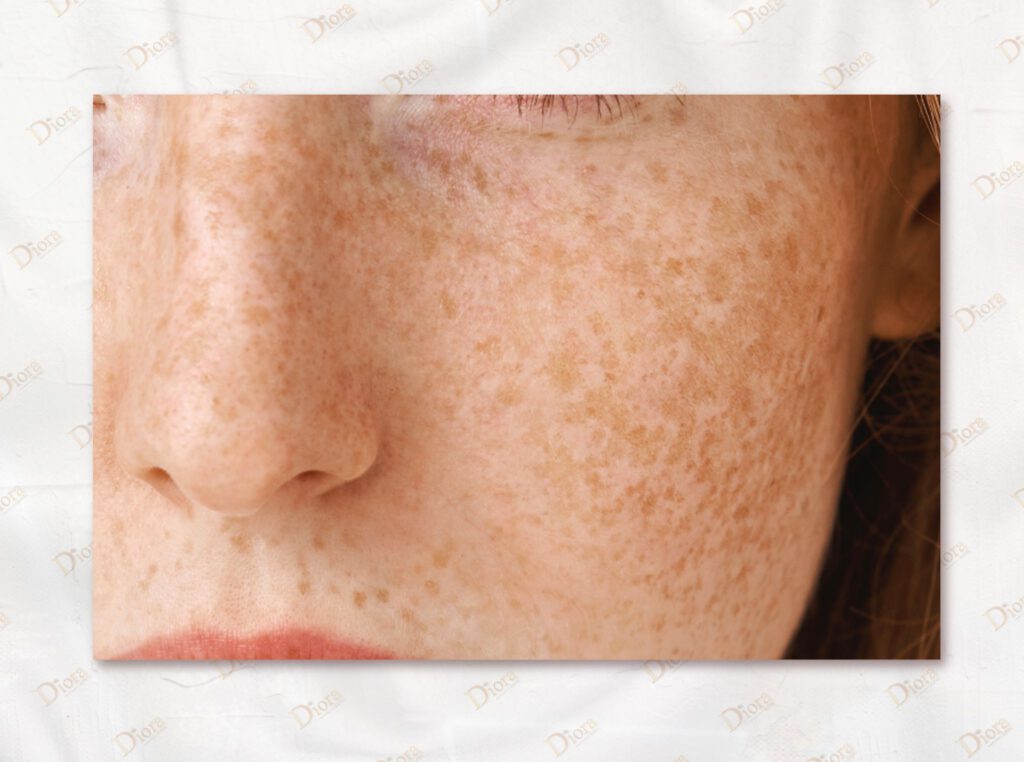 melasma