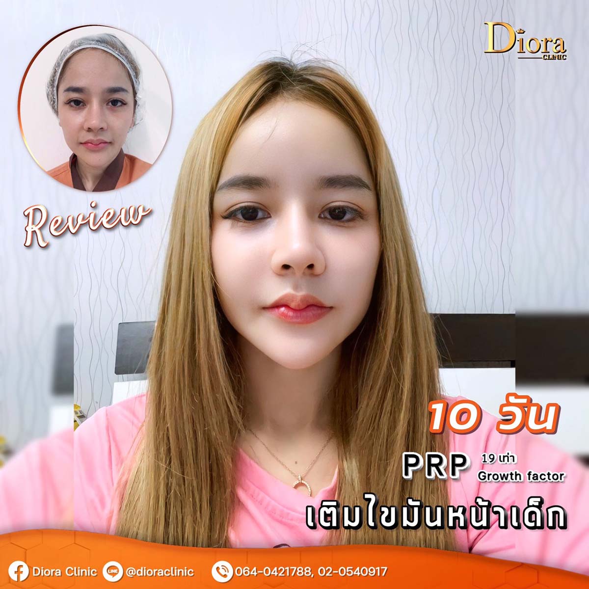 รีวิวหลังฉีดไขมันหน้า 10 วัน