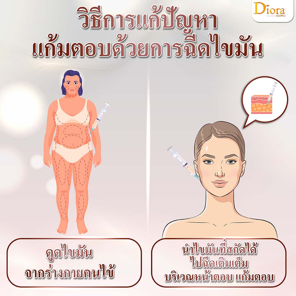 ฉีดไขมัน แก้ปัญหาหน้าตอบ